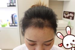 -大麦微针植发丨全国连锁