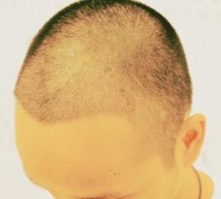 -大麦微针植发丨全国连锁