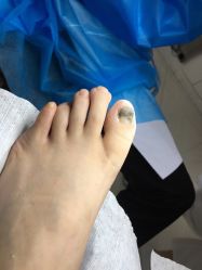 -派恩宜灰指甲鸡眼嵌甲手足癣