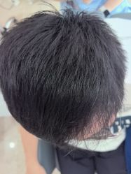-大麦微针植发丨全国连锁