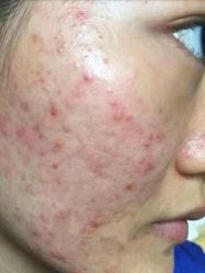 -金品苗方专业祛痘中心