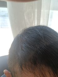 -碧莲盛·不剃发植发