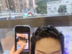 -碧莲盛·不剃发植发