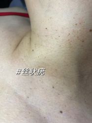 -爱莎扁平疣·汗管瘤·斑痣中心