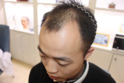 点击看大图 -大麦微针植发丨全国连锁