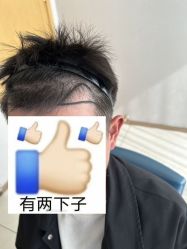 体验前-大麦微针植发丨全国连锁