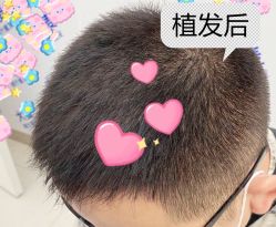 -大麦微针植发全国连锁