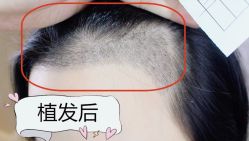 -大麦微针植发全国连锁