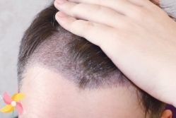 -大麦微针植发丨全国连锁