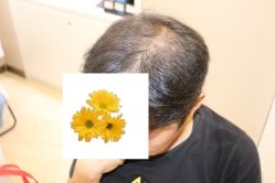 -大麦微针植发丨全国连锁