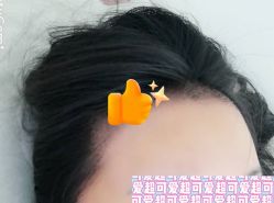 -大麦微针植发全国连锁