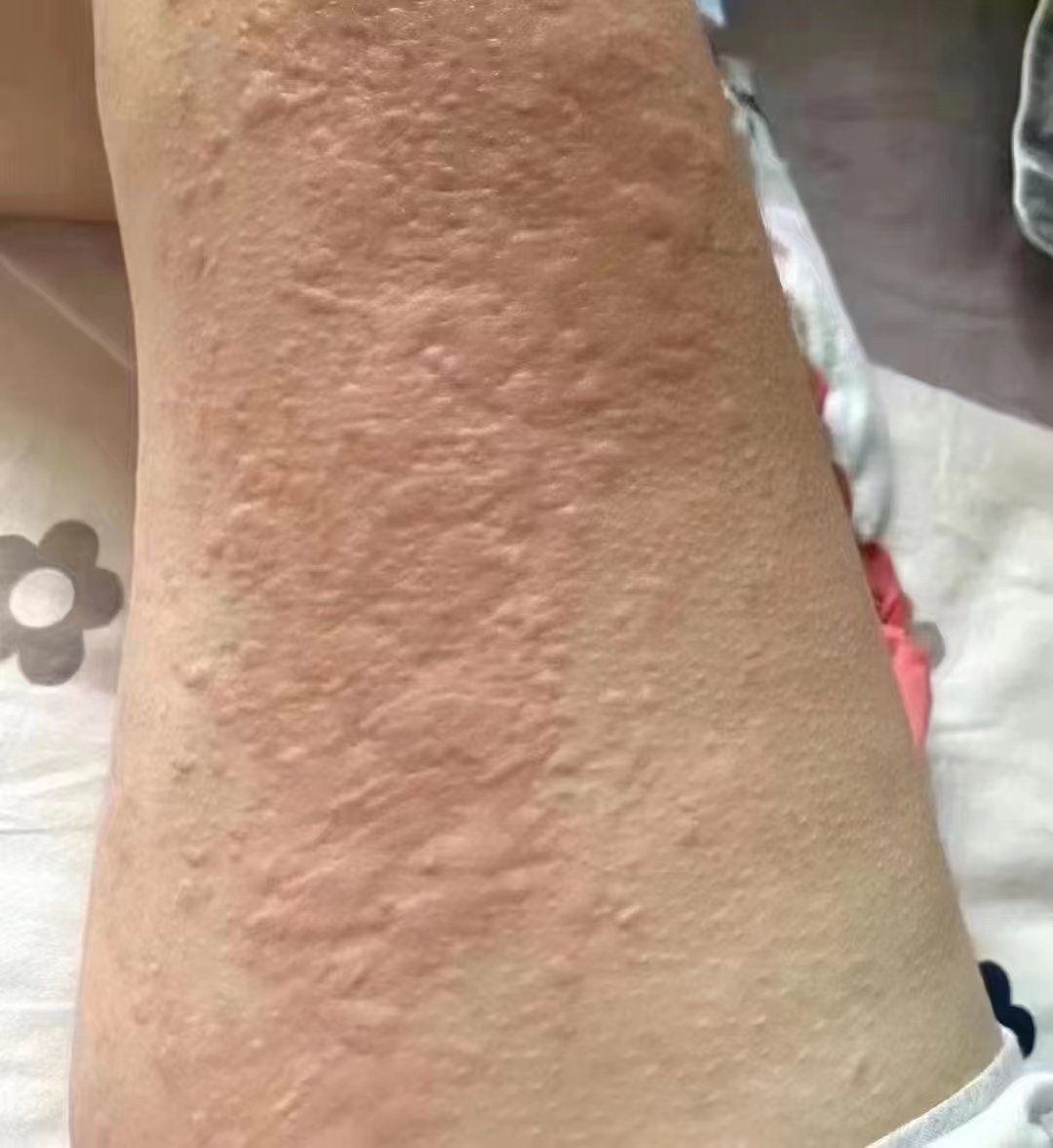 折磨人的荨麻疹在肝上