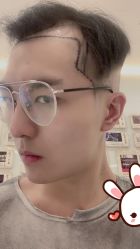 -大麦微针植发丨全国连锁