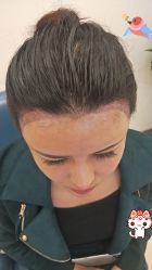 -大麦微针植发丨全国连锁