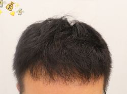 -大麦微针植发全国连锁