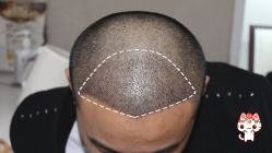 -大麦微针植发丨全国连锁