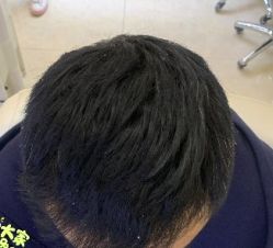 -大麦微针植发丨全国连锁
