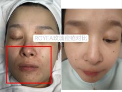 -ROYEA茹彦祛痘·问题肌肤修护中心