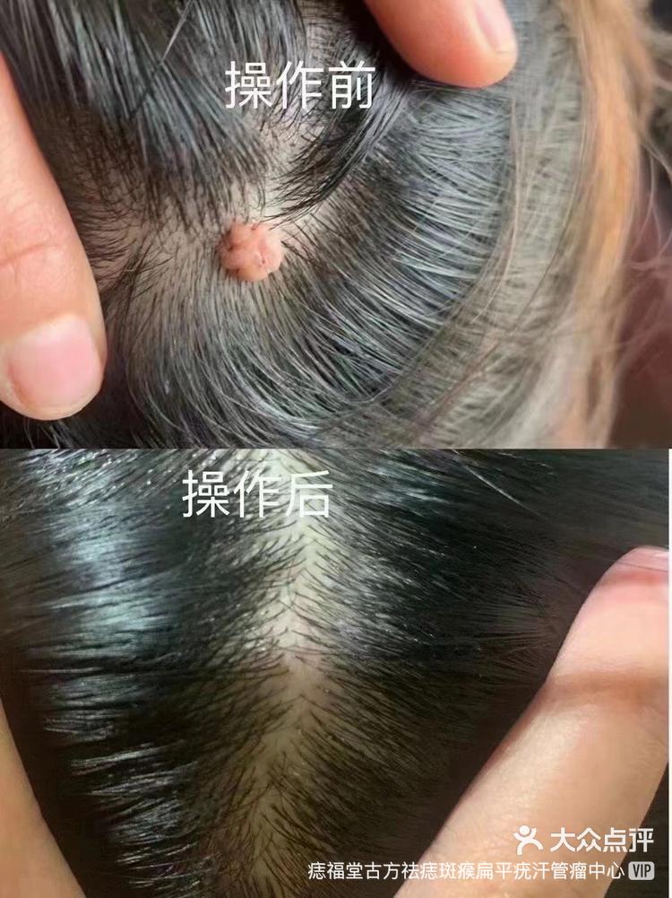 不剃头发不伤毛囊轻松搞定头上肉疙瘩