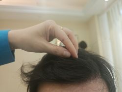 -碧莲盛·不剃发植发