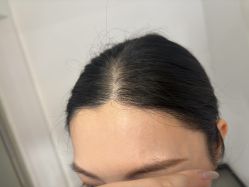 -大麦微针植发全国连锁