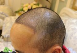 -大麦微针植发丨全国连锁