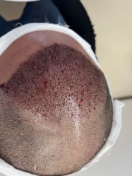 -大麦微针植发丨全国连锁