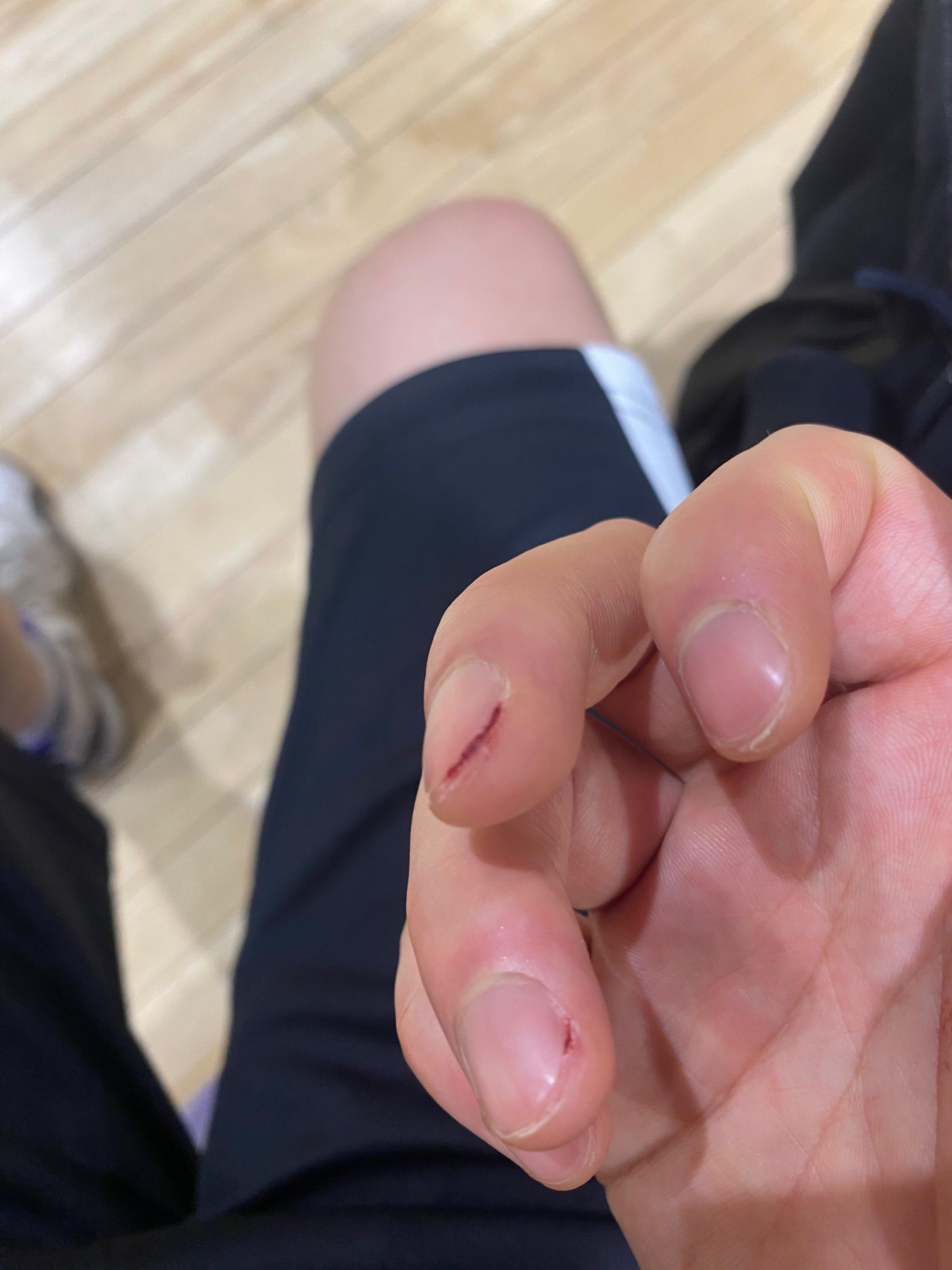 手指小伤不哭泣