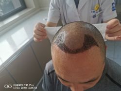 体验后-大麦微针植发丨全国连锁