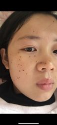 -北京美痣堂古方祛痣斑疣瘊