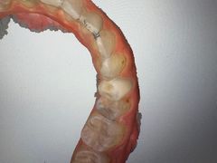 -上海仁爱医院口腔科 · 种植
