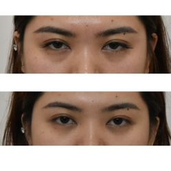 -广州健丽·去眼袋医疗美容机构