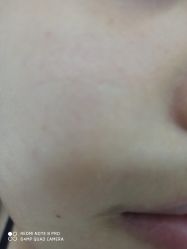 -佳慕祛痘皮肤管理连锁