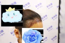 -大麦微针植发丨全国连锁