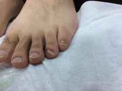 点击看大图 -德哥灰指甲脚气甲沟炎跖疣护理