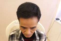 -大麦微针植发丨全国连锁