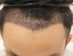 -大麦微针植发丨全国连锁