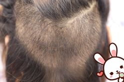 点击看大图 -大麦微针植发丨全国连锁