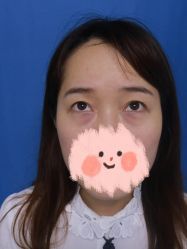 体验前-广州健丽·去眼袋医疗美容机构