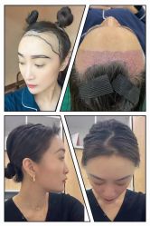 点击看大图 -熙朵美学植发连锁