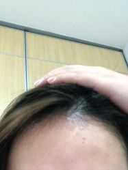 体验后-大麦微针植发全国连锁