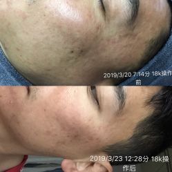 -苗方清颜·祛痘皮肤管理