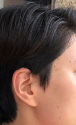 -爱莎扁平疣·汗管瘤·斑痣中心