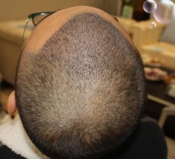 -大麦微针植发丨全国连锁