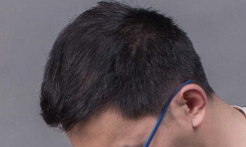 -大麦微针植发丨全国连锁