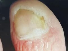 -世龙世家灰指甲鸡眼脚气甲沟炎跖疣护理(通州店)