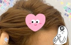 -大麦微针植发全国连锁