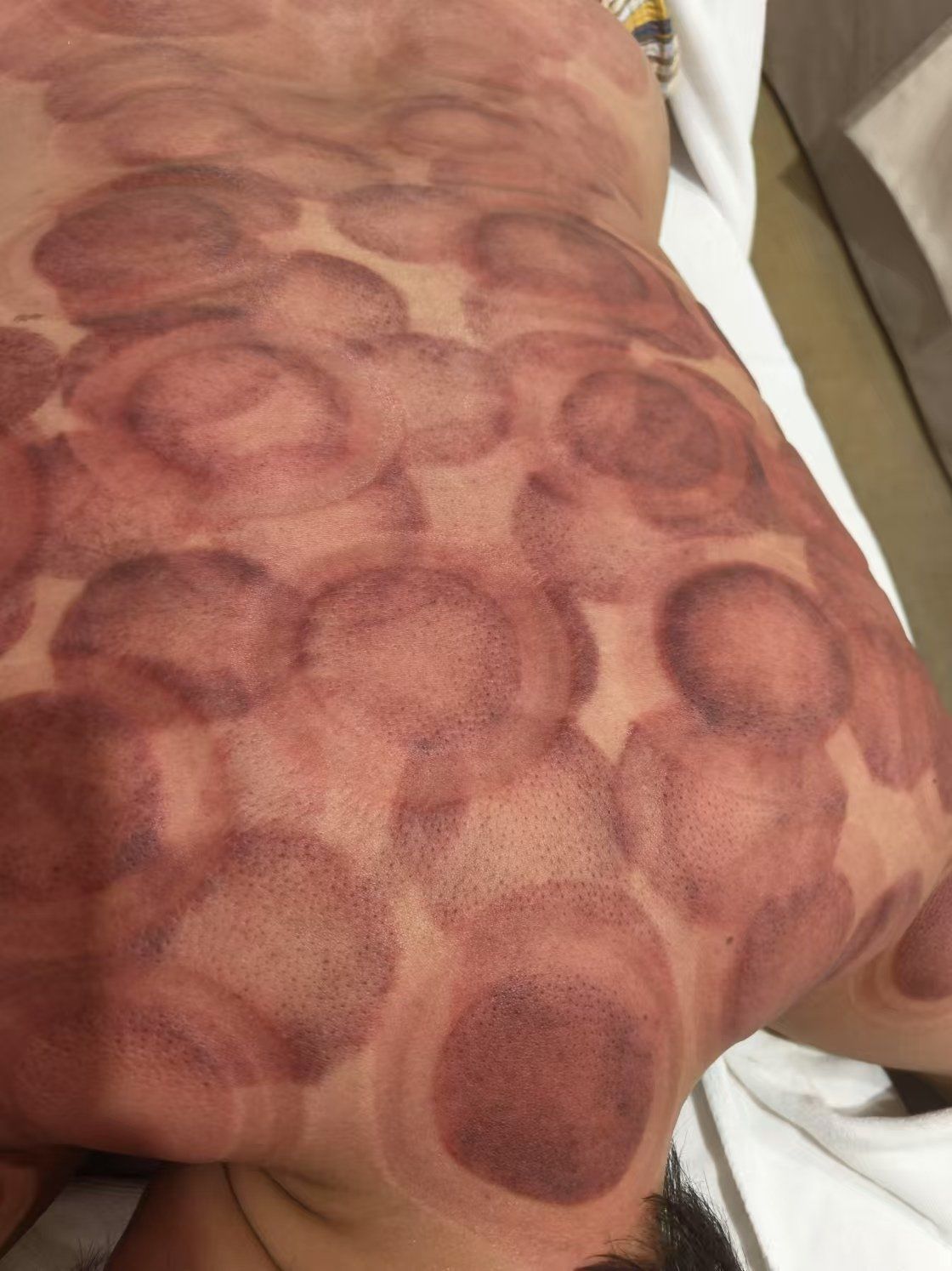 拔罐疗法,中医也能时尚!