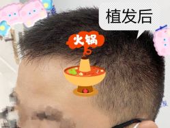 -大麦微针植发全国连锁