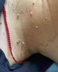 -苗方清颜专业祛痘连锁机构